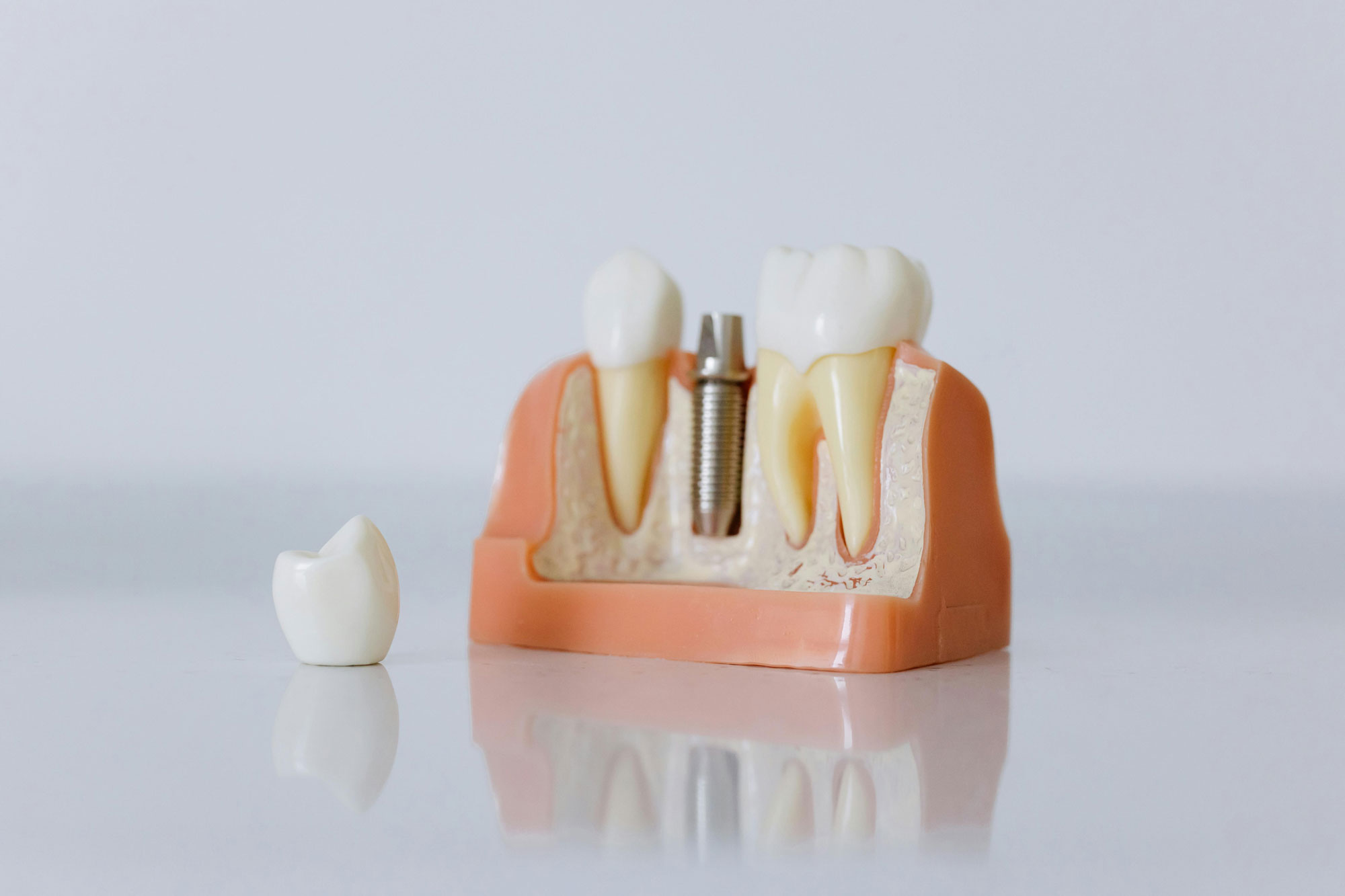 Dental Bridges